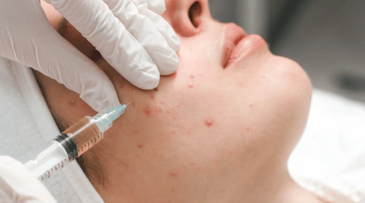 Why Professional Treatments Are Essential for Acne Facials?