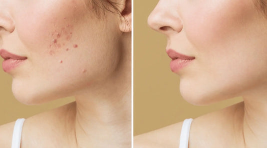 What Are The Best Facials For Acne Scars And Dark Spots Removal?