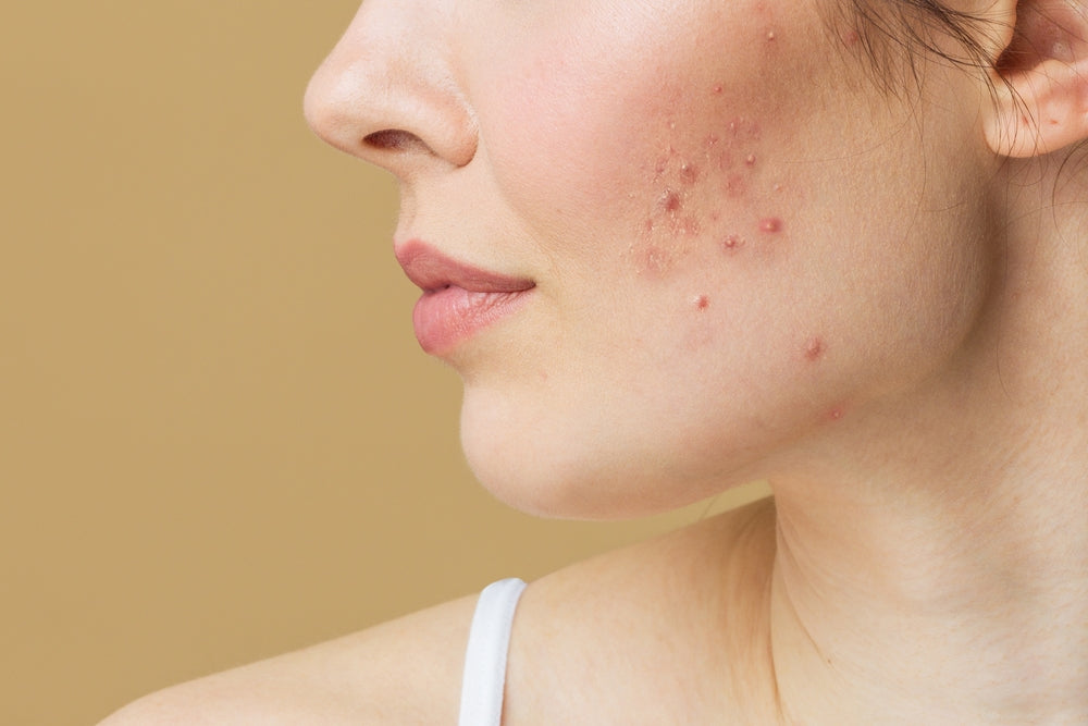 What To Know About Hormonal Acne According to a Dermatologist?