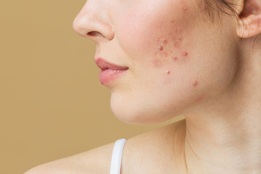 What To Know About Hormonal Acne According to a Dermatologist?